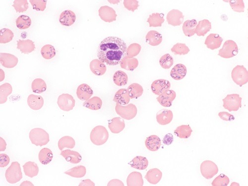 Babesiosis on the rise